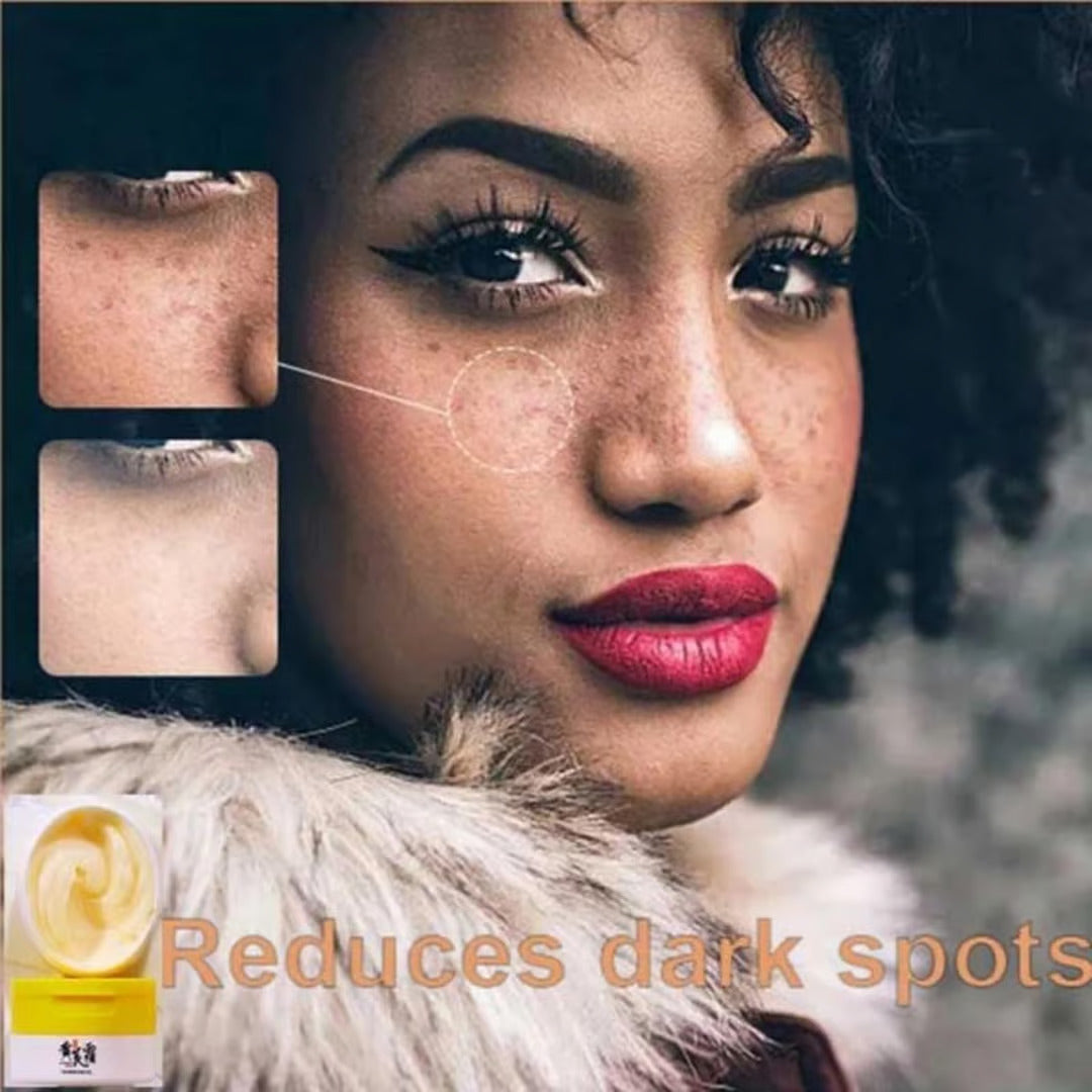 Dark Spots and Acne Removal Cream (BUY 1 GET 1 FREE)