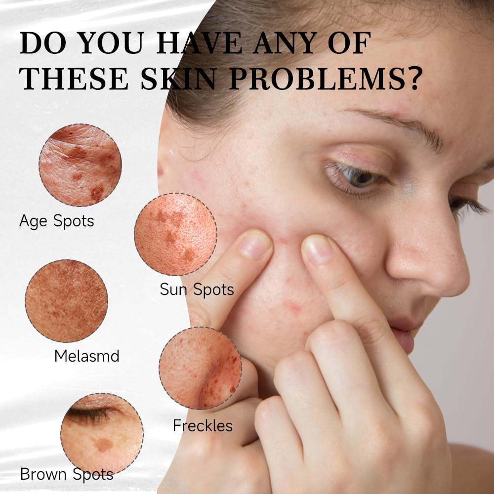 aobenz Dark Spot Remover Serum for Face & Body - Advanced Corrector Serum for Age, Melasma, Sun, Acne & Black Spots